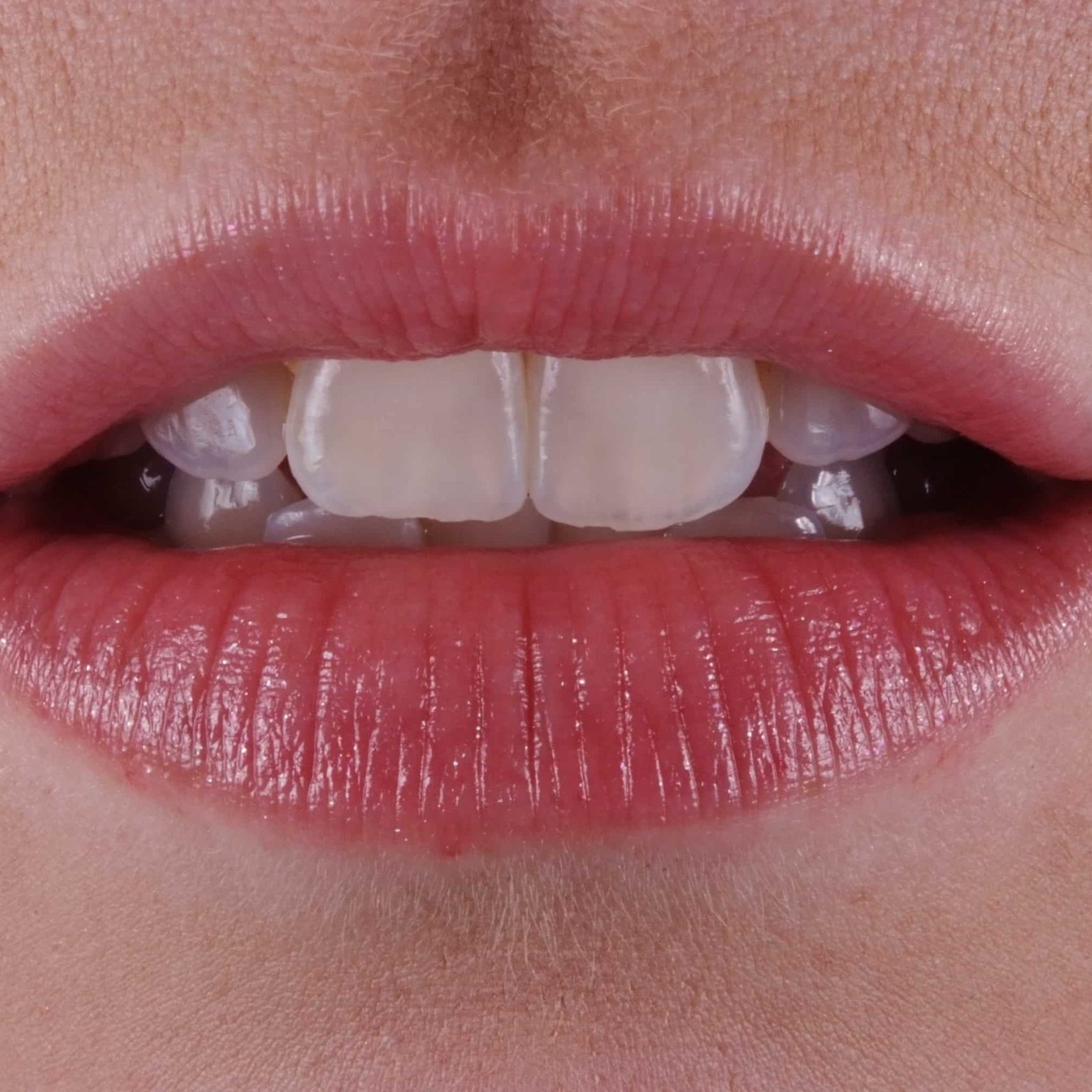 Dental Lip Lift